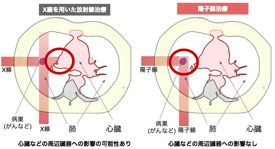 陽子線治療のイメージ